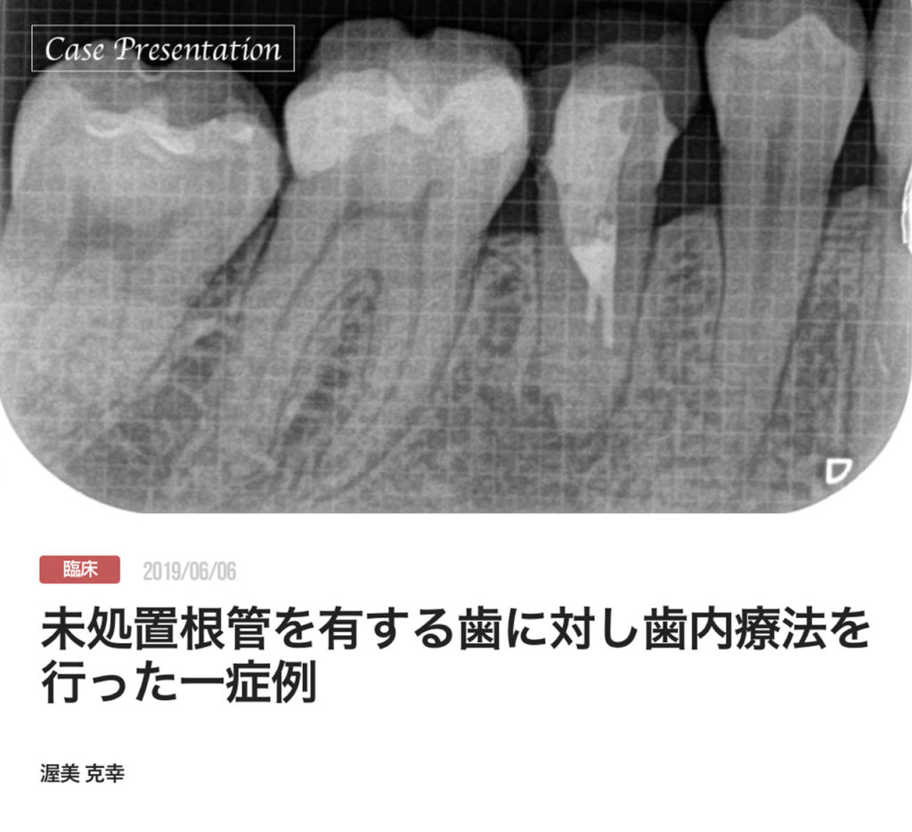 未処置根管を有する歯に対し歯内療法を行った一症例