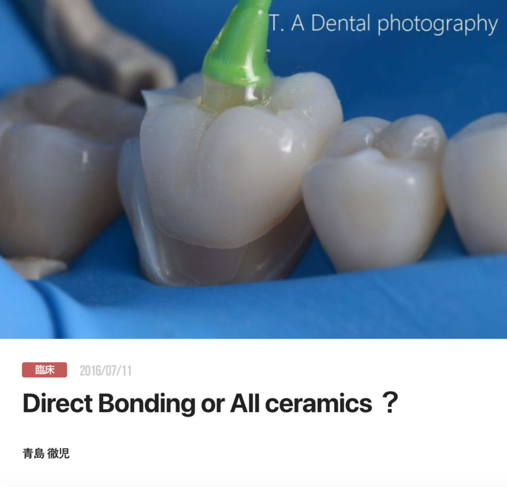 Direct Bonding or All ceramics ？