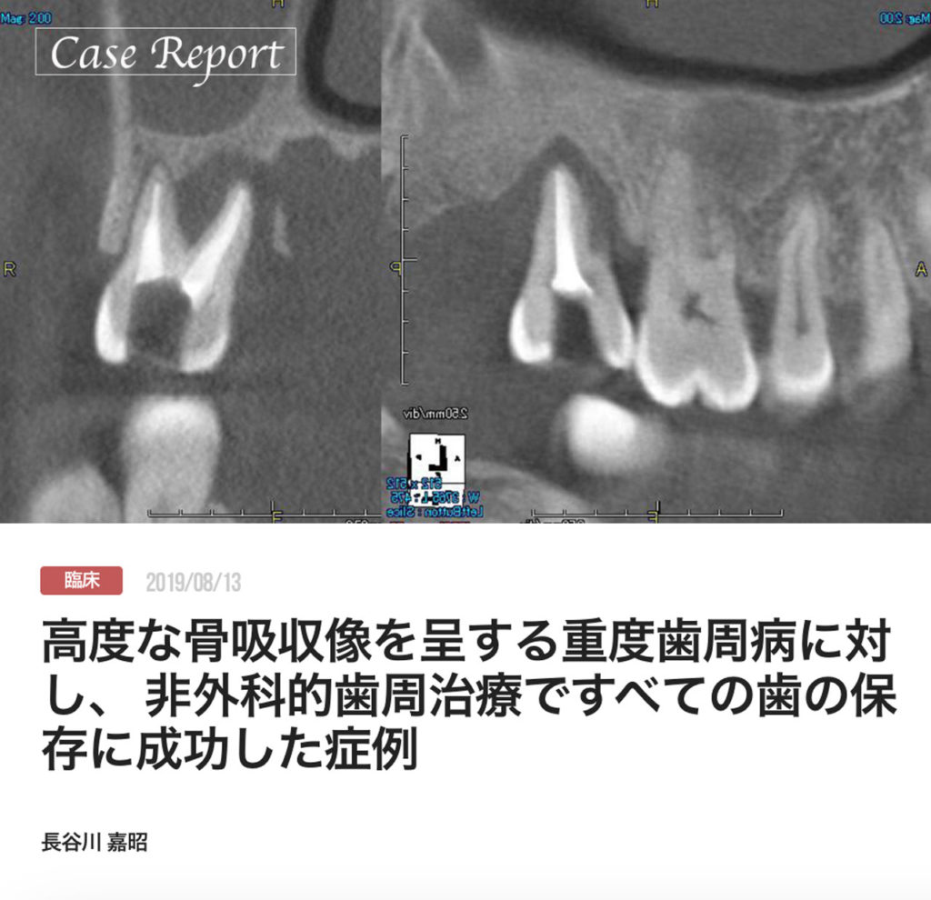 高度な骨吸収像を呈する重度歯周病に対し、 非外科的歯周治療ですべての歯の保存に成功した症例