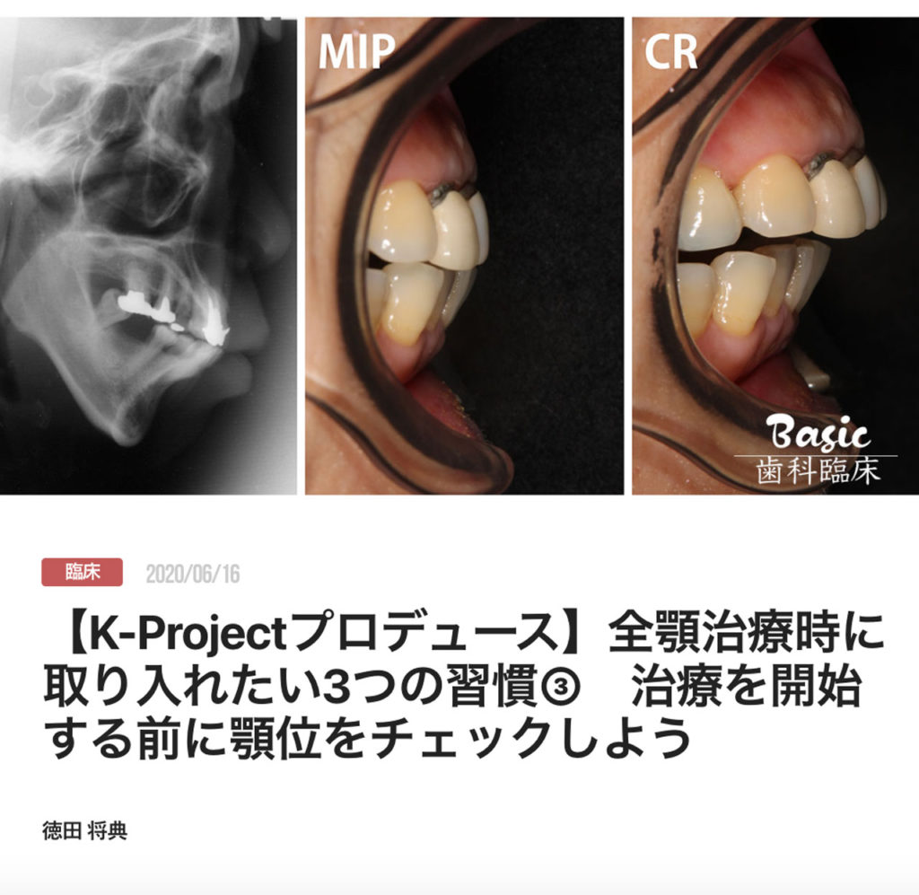 【K-Projectプロデュース】全顎治療時に取り入れたい3つの習慣③　治療を開始する前に顎位をチェックしよう