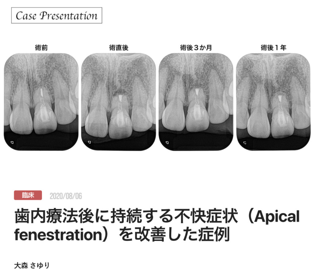 歯内療法後に持続する不快症状（Apical fenestration）を改善した症例
