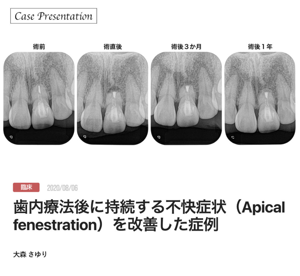 歯内療法後に持続する不快症状（Apical fenestration）を改善した症例