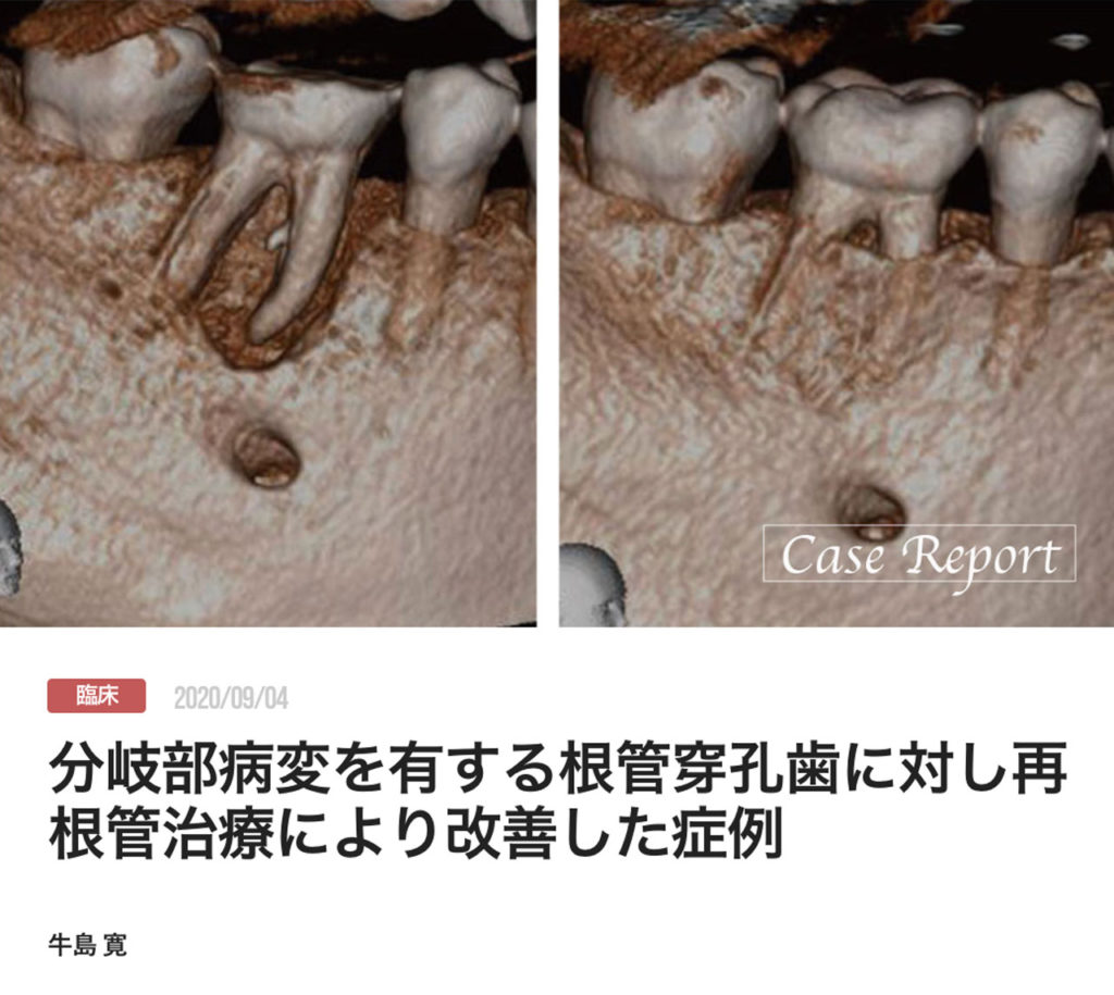 分岐部病変を有する根管穿孔歯に対し再根管治療により改善した症例