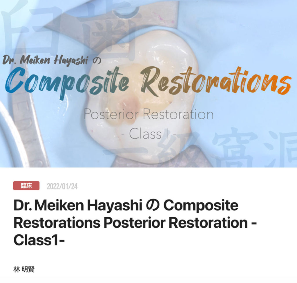 Dr. Meiken Hayashi の Composite Restorations Posterior Restoration -Class1-