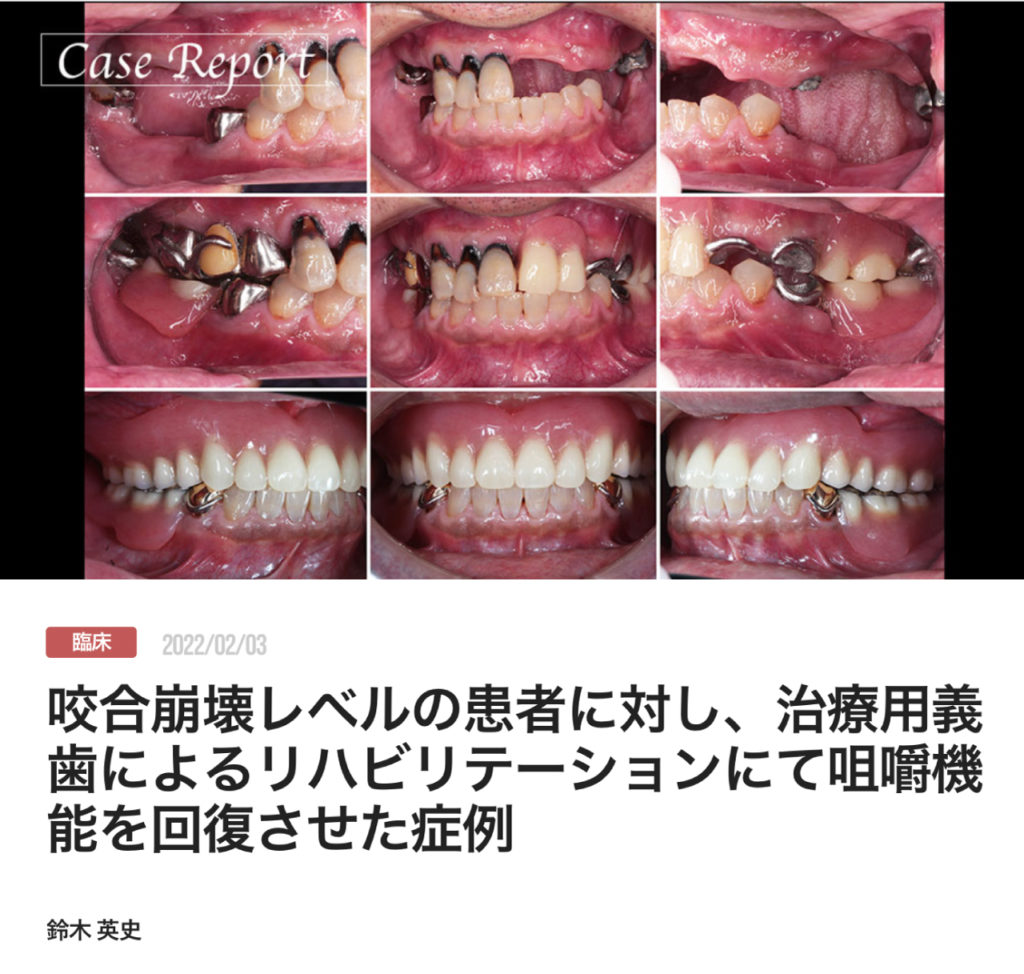 咬合崩壊レベルの患者に対し、治療用義歯によるリハビリテーションにて咀嚼機能を回復させた症例