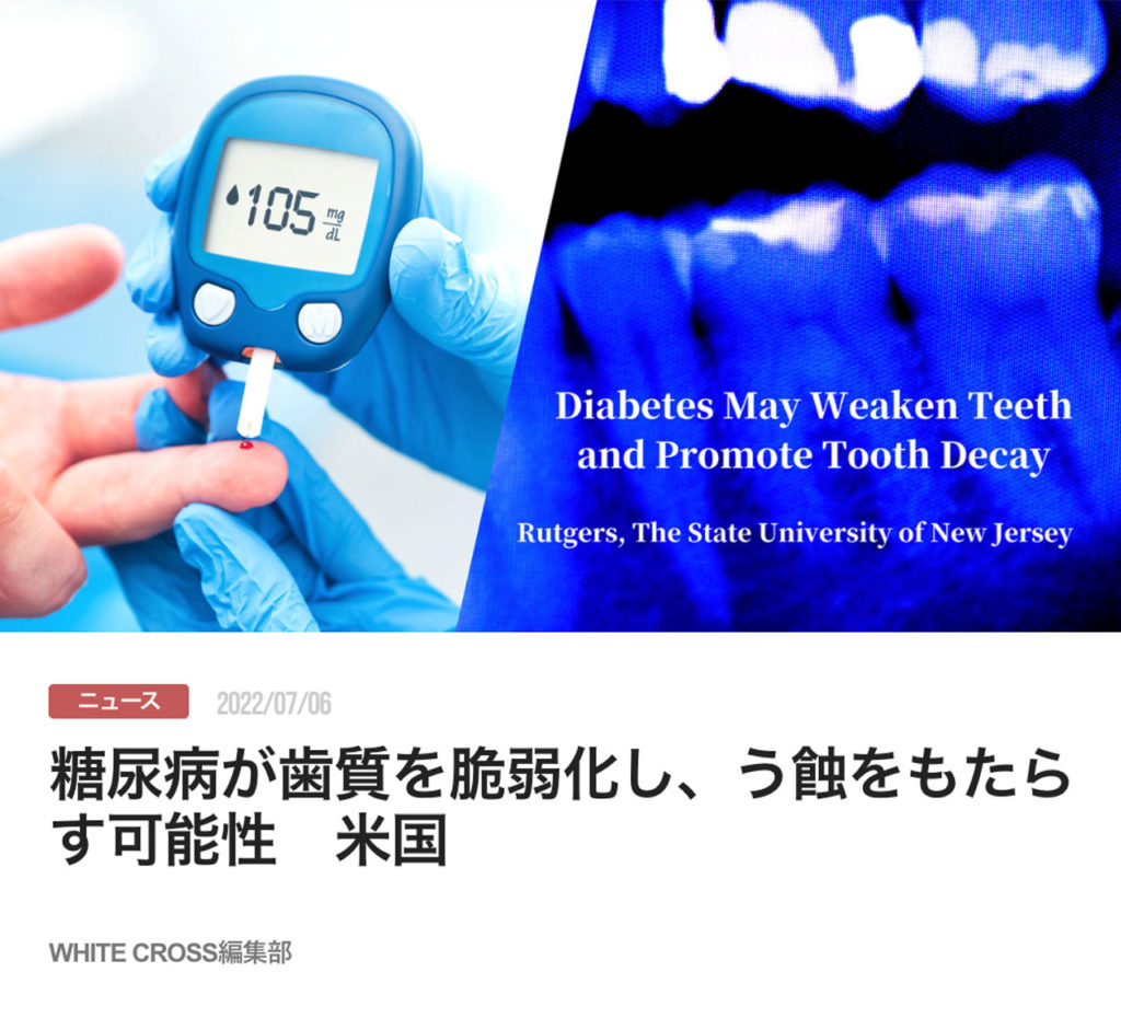 糖尿病が歯質を脆弱化し、う蝕をもたらす可能性　米国
