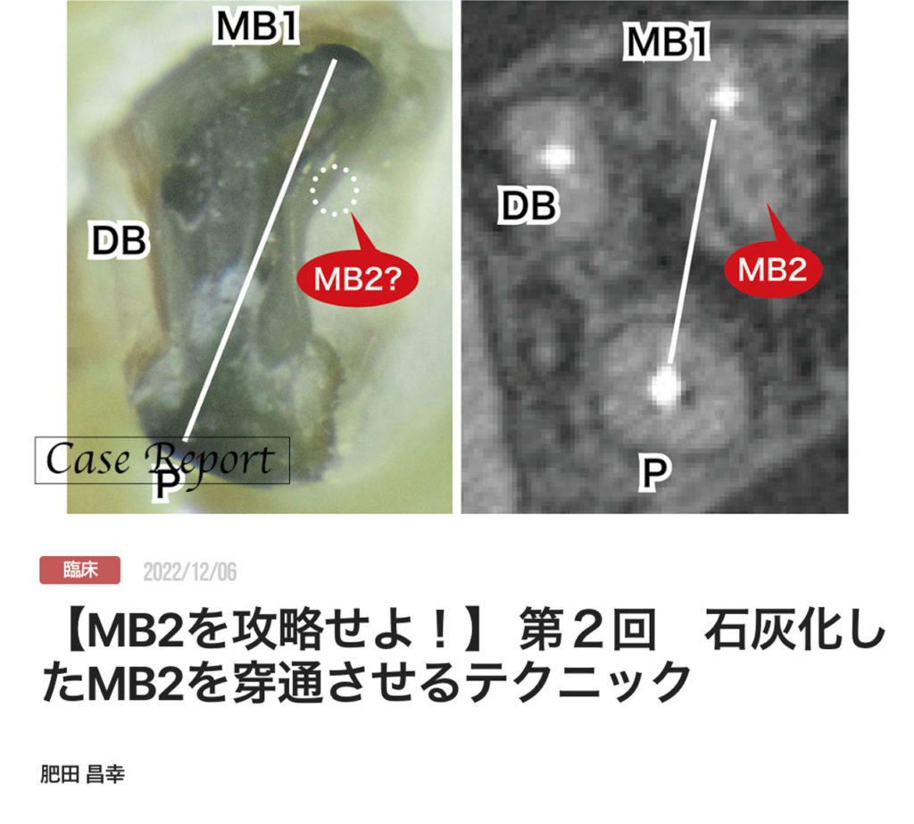 【MB2を攻略せよ！】 第２回　石灰化したMB2を穿通させるテクニック