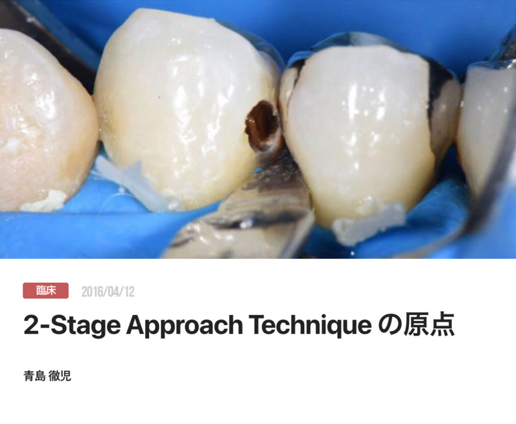 2-Stage Approach Technique の原点