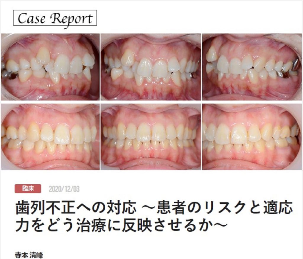 歯列不正への対応 〜患者のリスクと適応力をどう治療に反映させるか〜