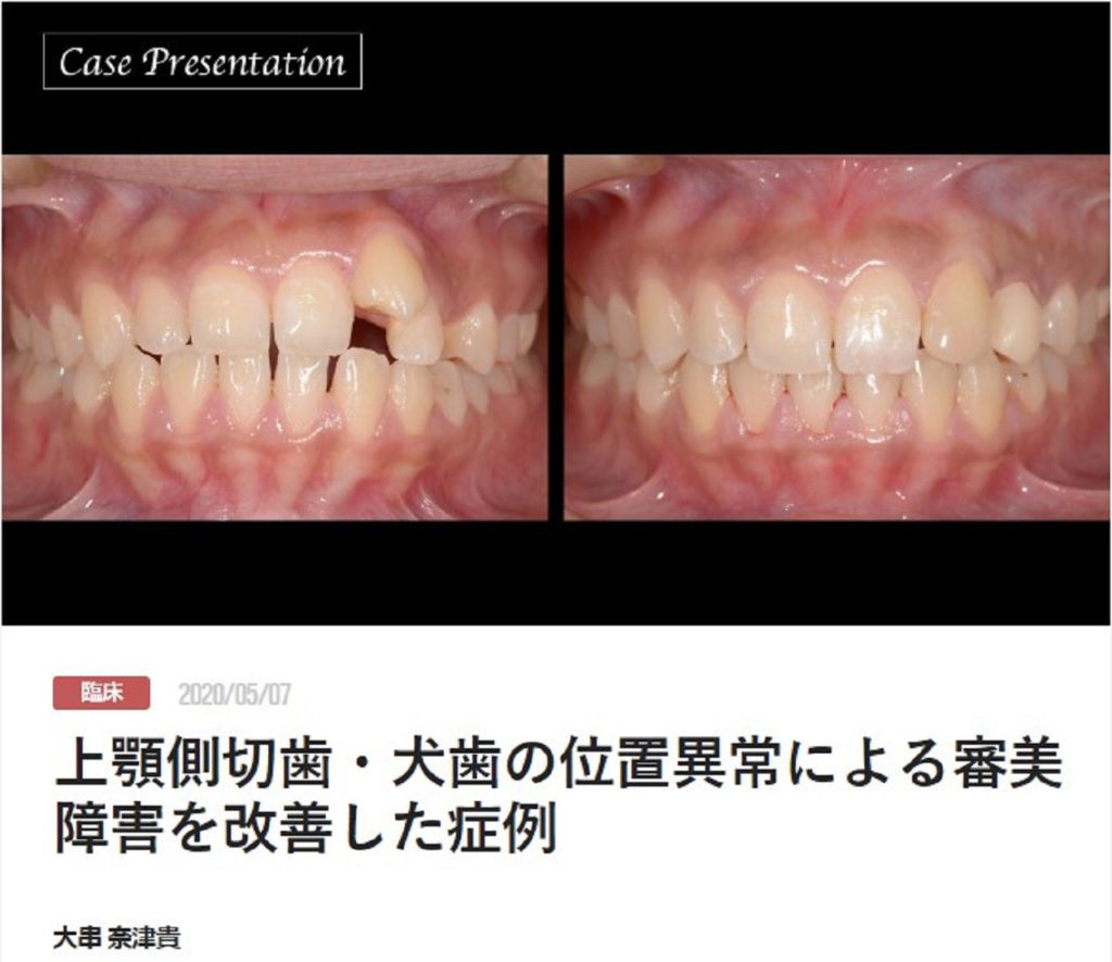 上顎側切歯・犬歯の位置異常による審美障害を改善した症例