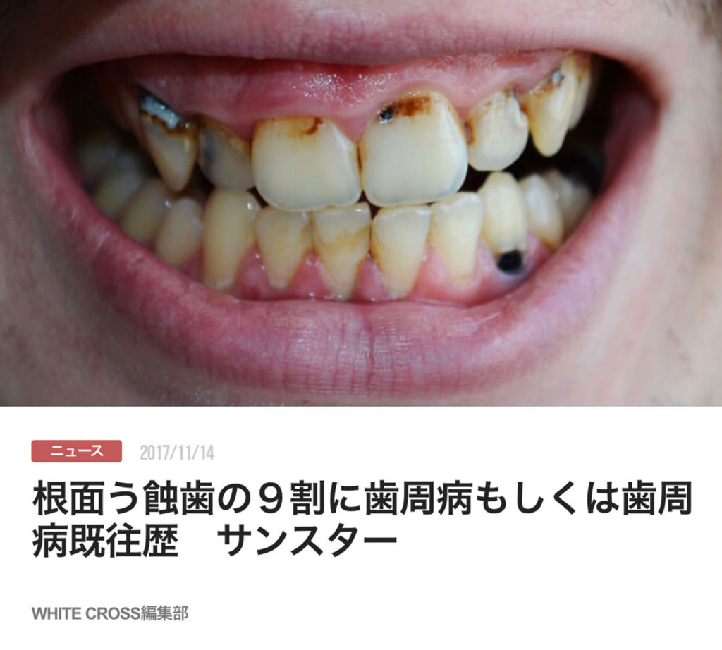 根面う蝕歯の９割に歯周病もしくは歯周病既往歴　サンスター