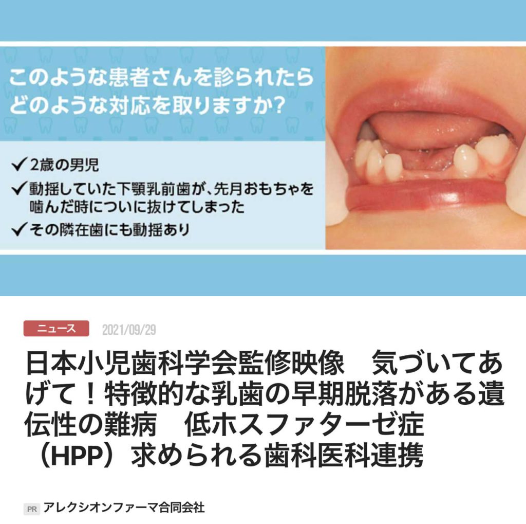 日本小児歯科学会監修映像　気づいてあげて！特徴的な乳歯の早期脱落がある遺伝性の難病　低ホスファターゼ症（HPP）求められる歯科医科連携