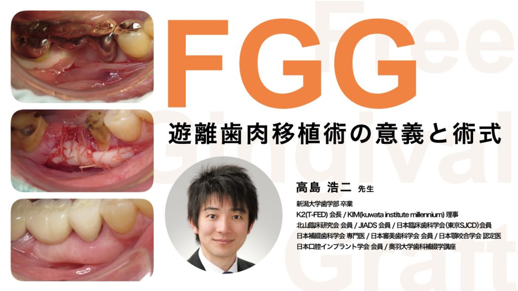 FGG 遊離歯肉移植術の意義と術式