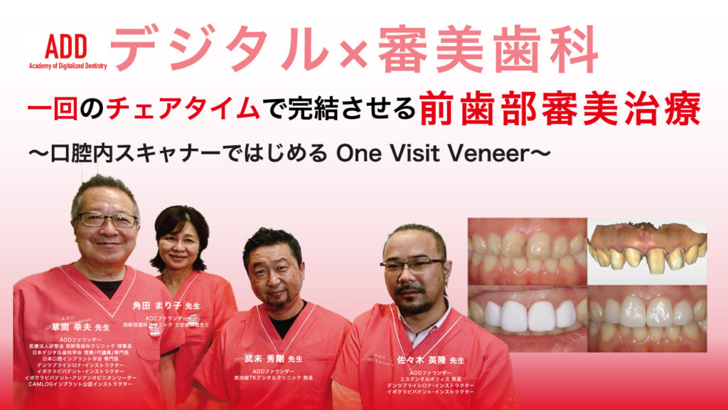 一回のチェアタイムで完結させる前歯部審美治療〜口腔内スキャナーではじめるOne Visit Veneer〜