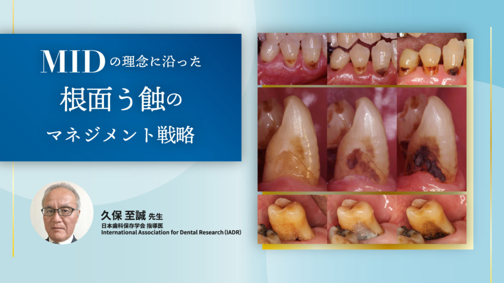 MIDの理念に沿った根面う蝕のマネジメント戦略