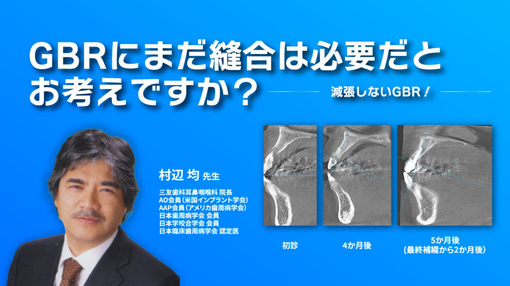 GBRにまだ縫合は必要だとお考えですか？減張しないGBR！