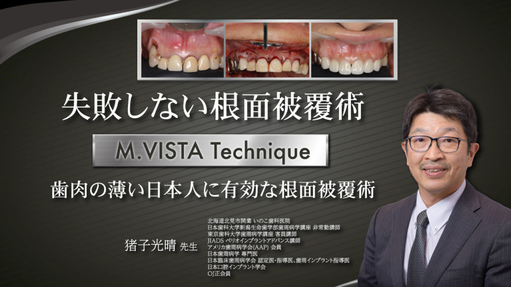 失敗しない根面被覆術 M.VISTA Technique 歯肉の薄い日本人に有効な根面被覆術