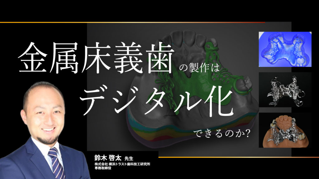 金属床義歯の製作はデジタル化できるのか？