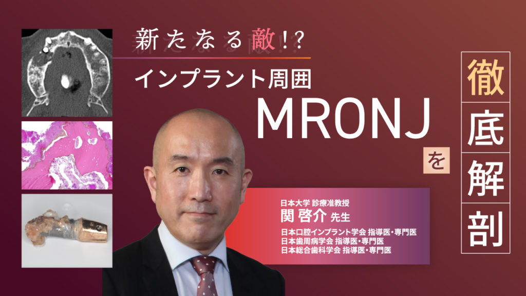 新たなる敵 ！？「インプラント周囲MRONJ」を徹底解剖