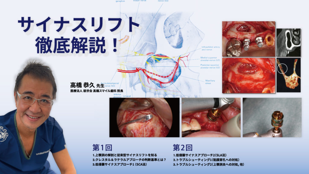 サイナスリフト徹底解説！