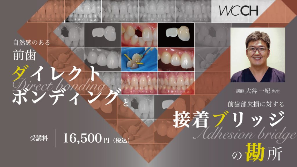 自然感のある前歯ダイレクトボンディングと、前歯部欠損に対する接着ブリッジの勘所