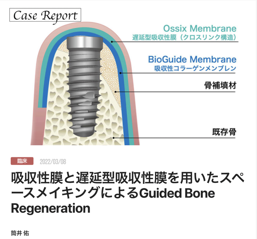 吸収性膜と遅延型吸収性膜を用いたスペースメイキングによるGuided Bone Regeneration
