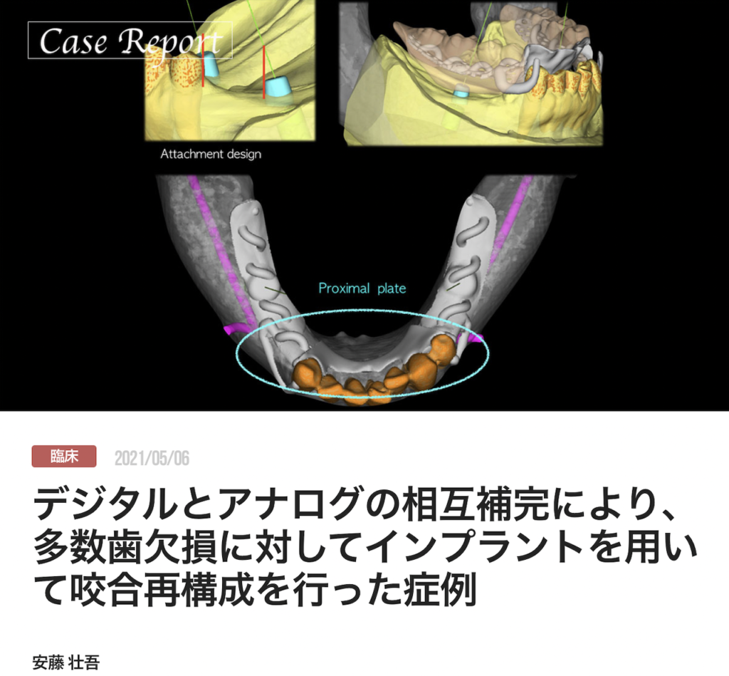 デジタルとアナログの相互補完により、多数歯欠損に対してインプラントを用いて咬合再構成を行った症例