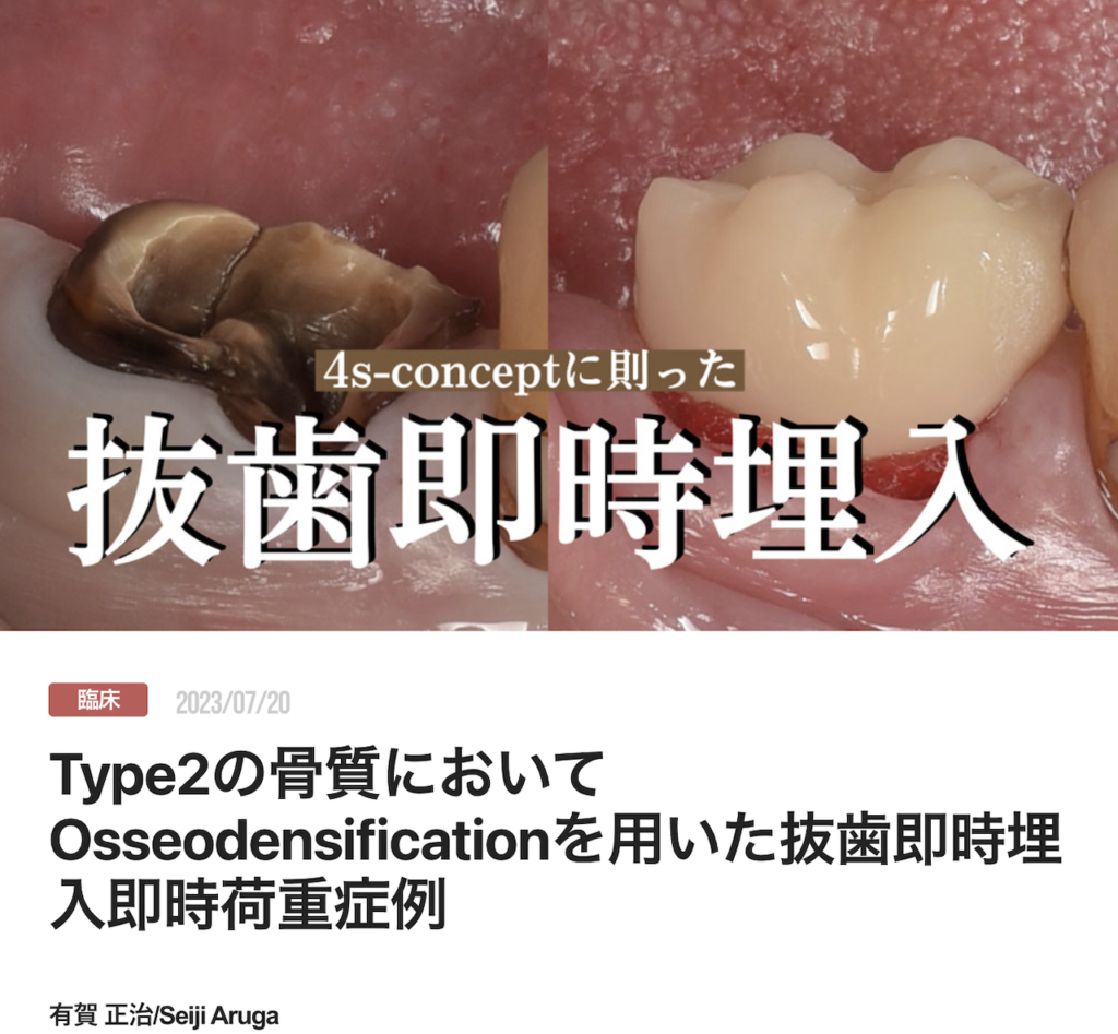 Type2の骨質においてOsseodensificationを用いた抜歯即時埋入即時荷重症例