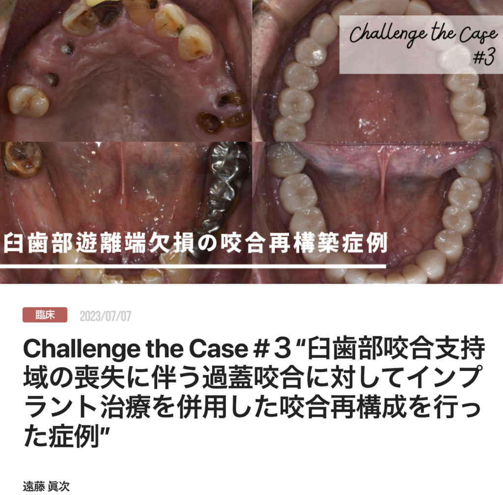 Challenge the Case #３“臼歯部咬合支持域の喪失に伴う過蓋咬合に対してインプラント治療を併用した咬合再構成を行った症例”