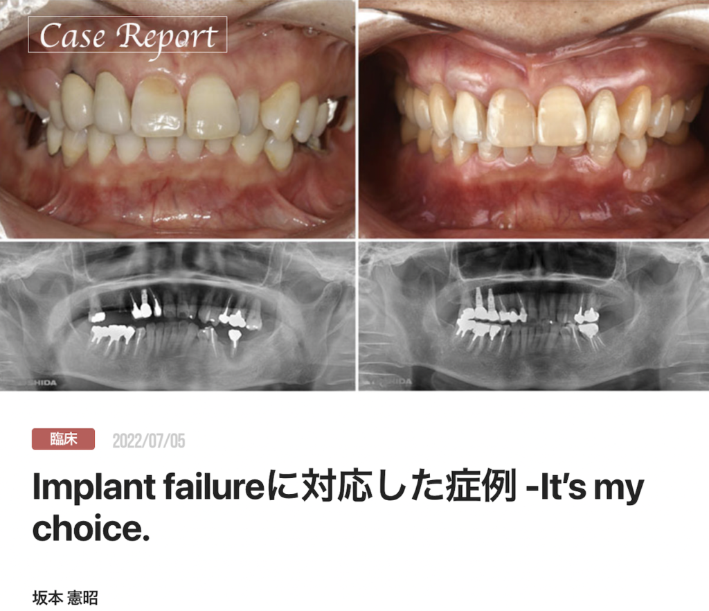 Implant failureに対応した症例 -It’s my choice.