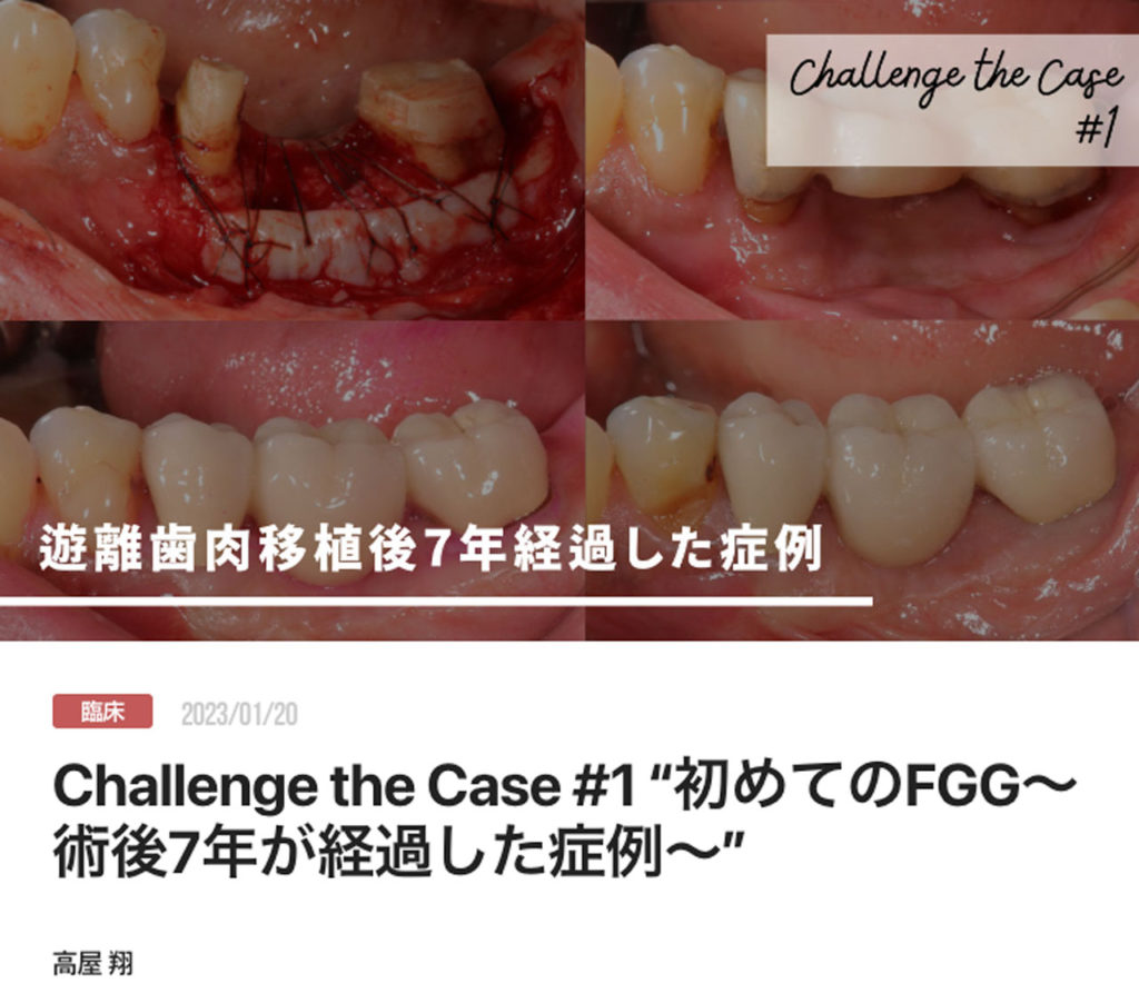 Challenge the Case #1 “初めてのFGG〜術後7年が経過した症例〜”