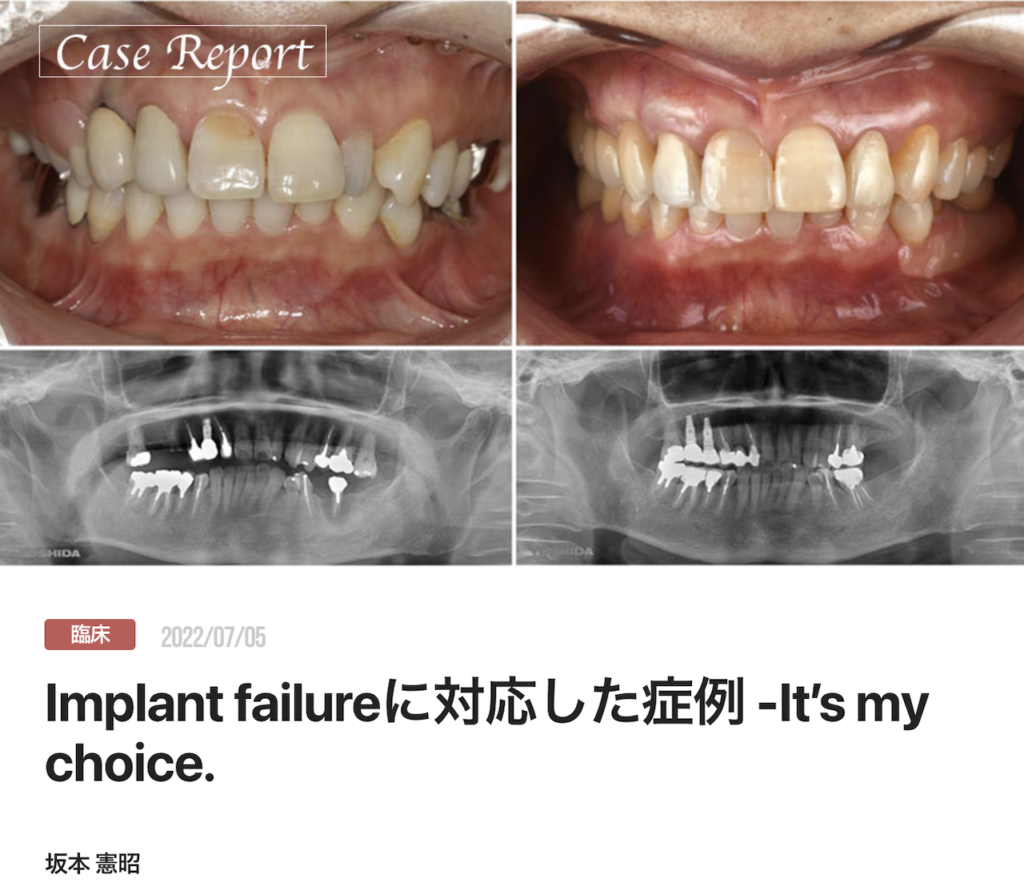 Implant failureに対応した症例 -It’s my choice.
