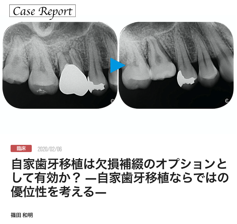 自家歯牙移植は欠損補綴のオプションとして有効か？ ―自家歯牙移植ならではの優位性を考える―