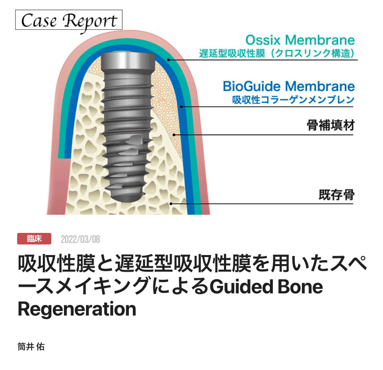 吸収性膜と遅延型吸収性膜を用いたスペースメイキングによるGuided Bone Regeneration