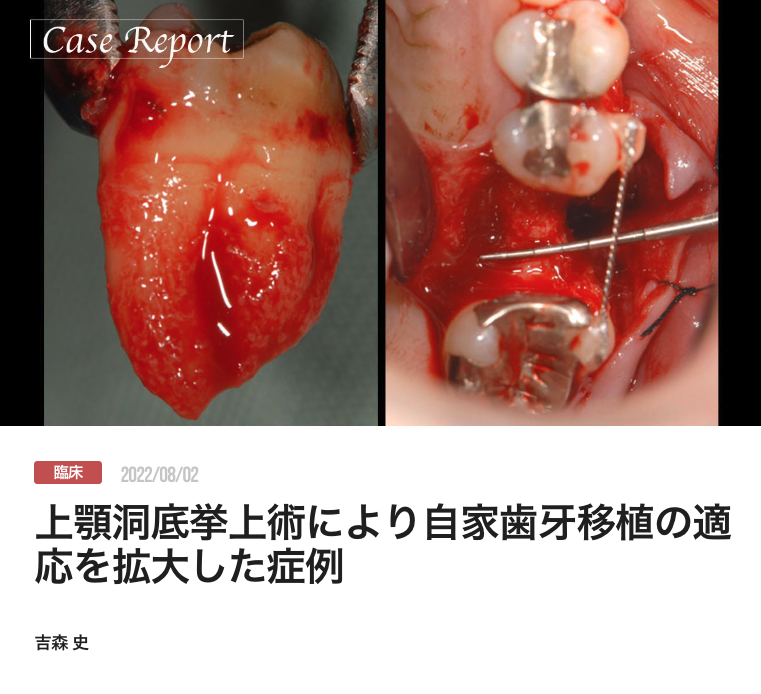 上顎洞底挙上術により自家歯牙移植の適応を拡大した症例