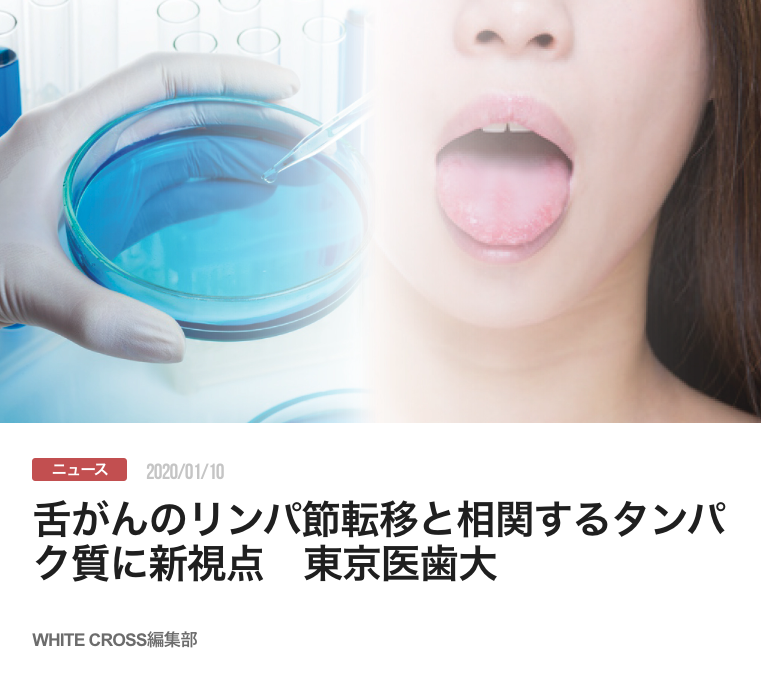 舌がんのリンパ節転移と相関するタンパク質に新視点　東京医歯大