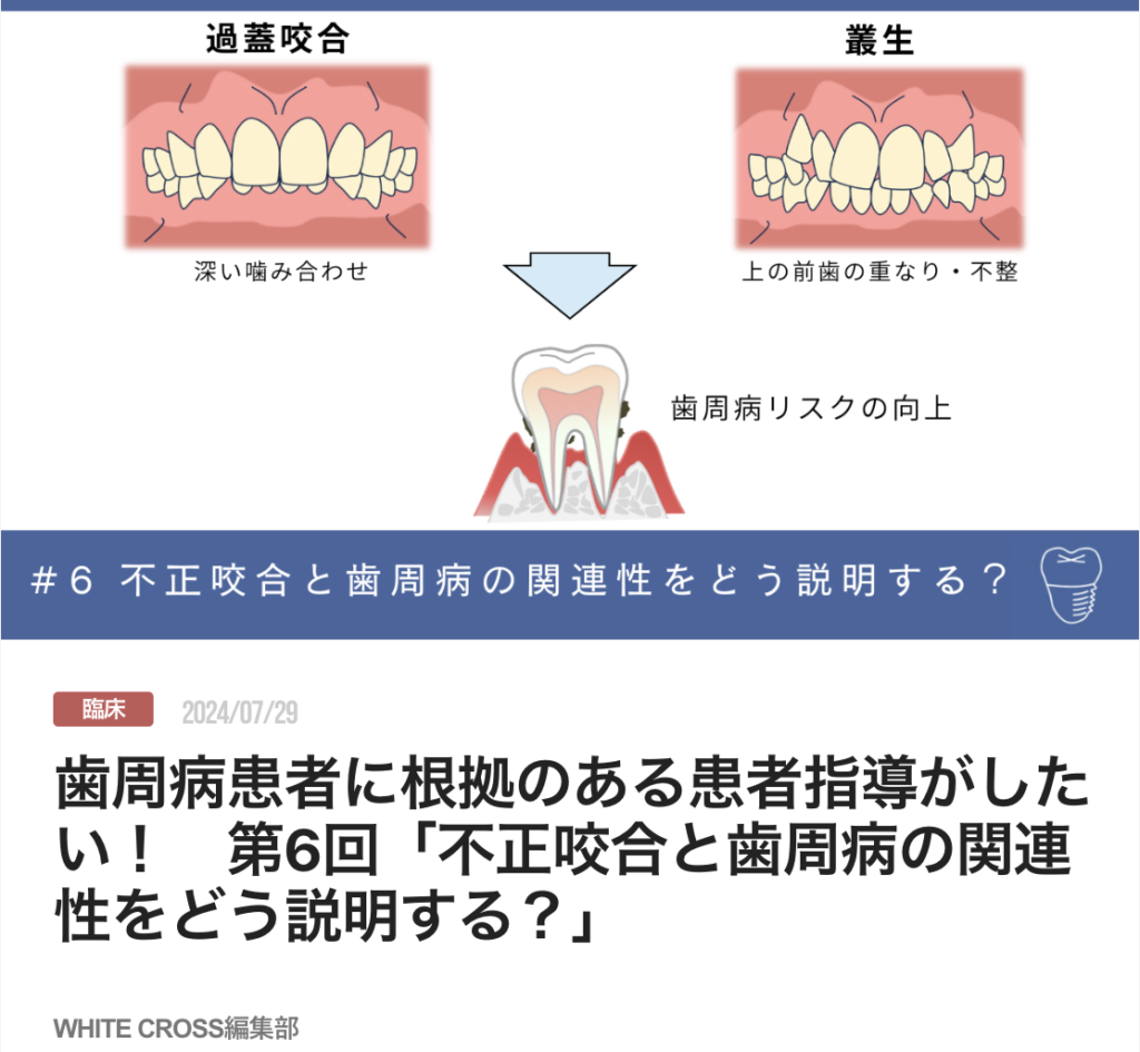 歯周病患者に根拠のある患者指導がしたい！　第6回「不正咬合と歯周病の関連性をどう説明する？」
