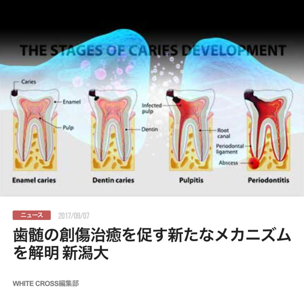 歯髄の創傷治癒を促す新たなメカニズムを解明 新潟大
