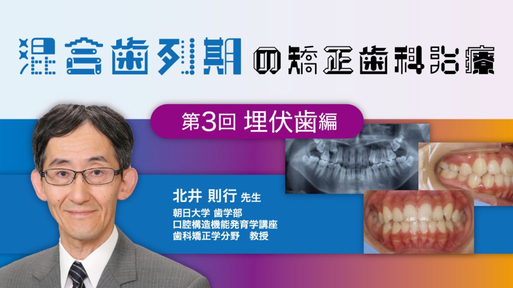 混合歯列期の矯正歯科治療　第3回　埋伏歯編