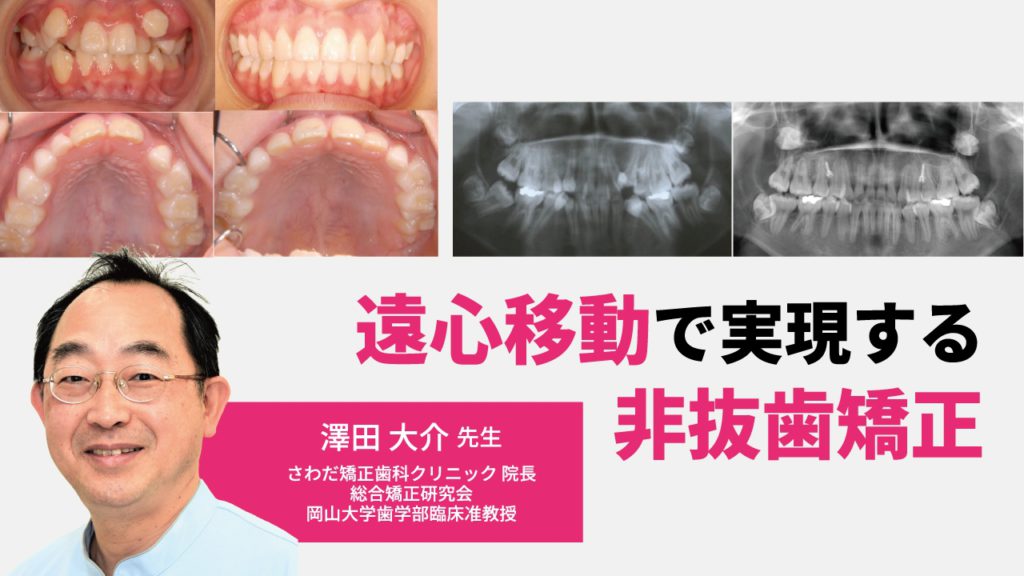 遠心移動で実現する非抜歯矯正