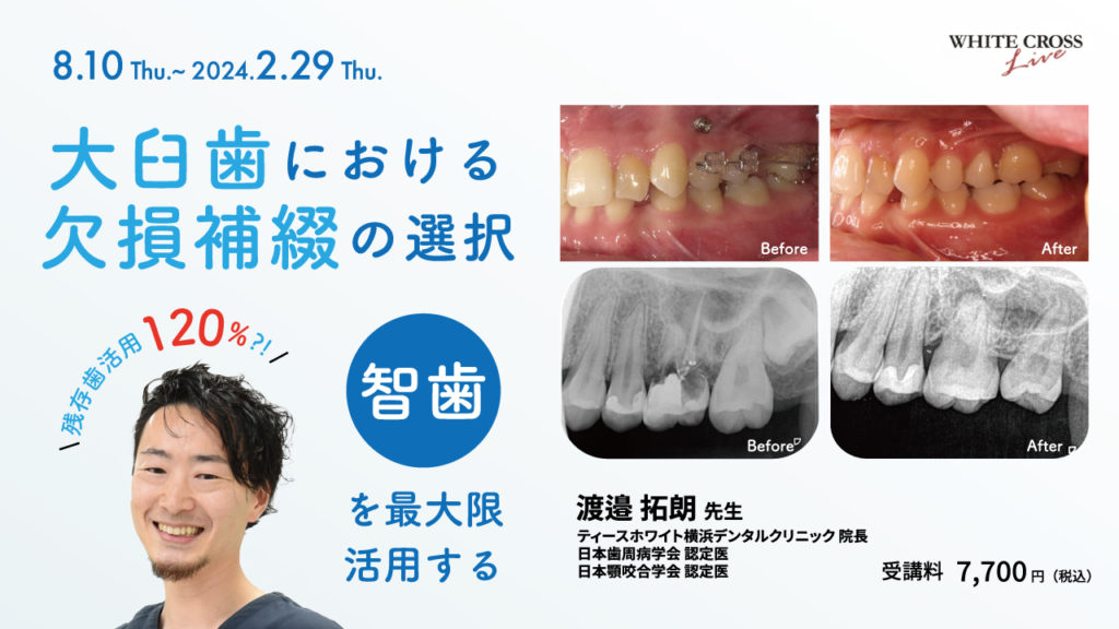 大臼歯における欠損補綴の選択