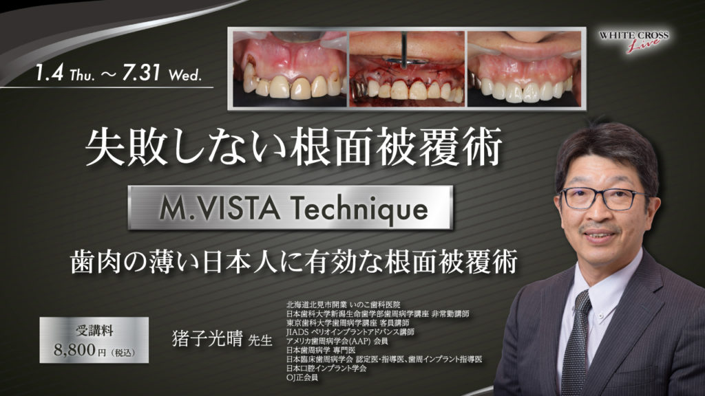 失敗しない根面被覆術 M.VISTA Technique 歯肉の薄い日本人に有効な根面被覆術