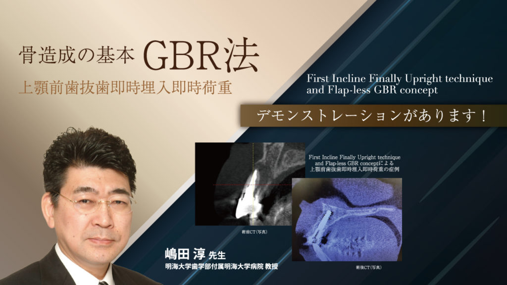 骨造成の基本 GBR法 上顎前歯抜歯即時埋入即時荷重（First Incline Finally Upright technique and Flap-less GBR concept）
