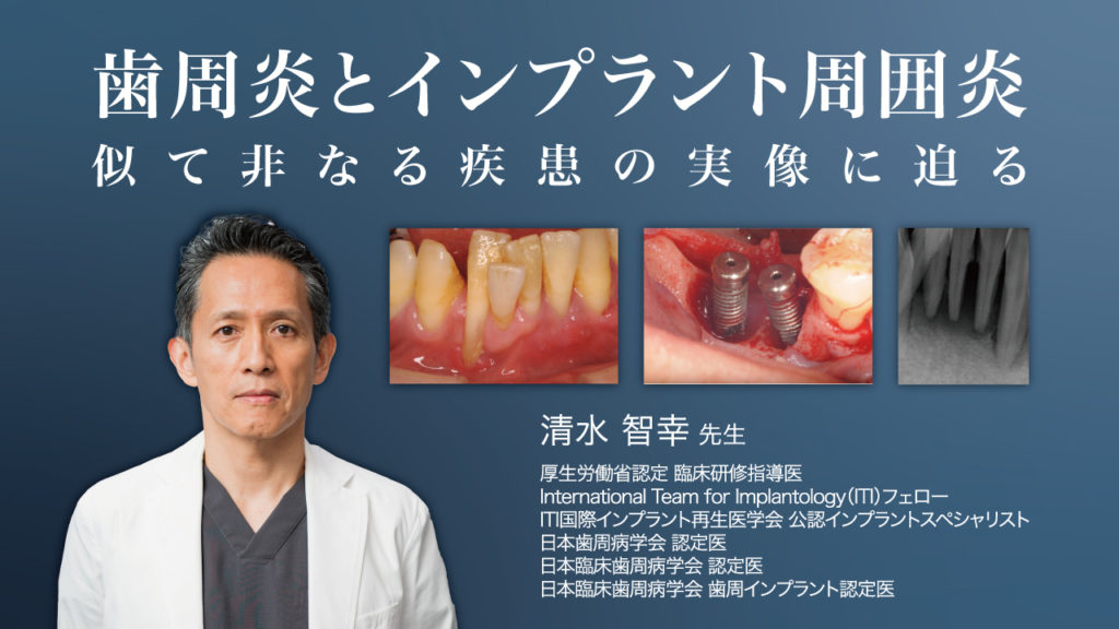 歯周炎とインプラント周囲炎 似て非なる疾患の実像に迫る