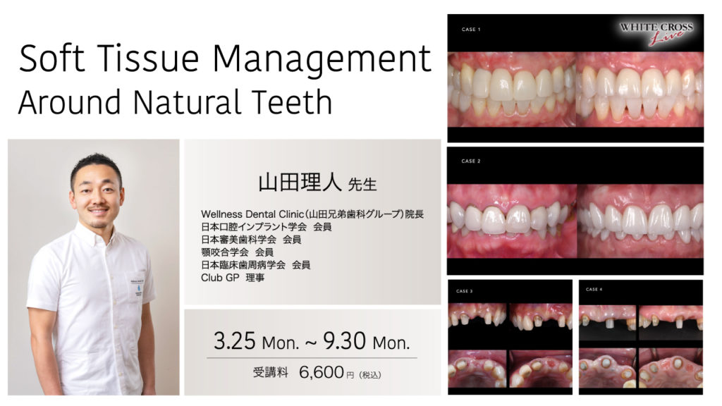 Soft Tissue Management Around Natural Teeth