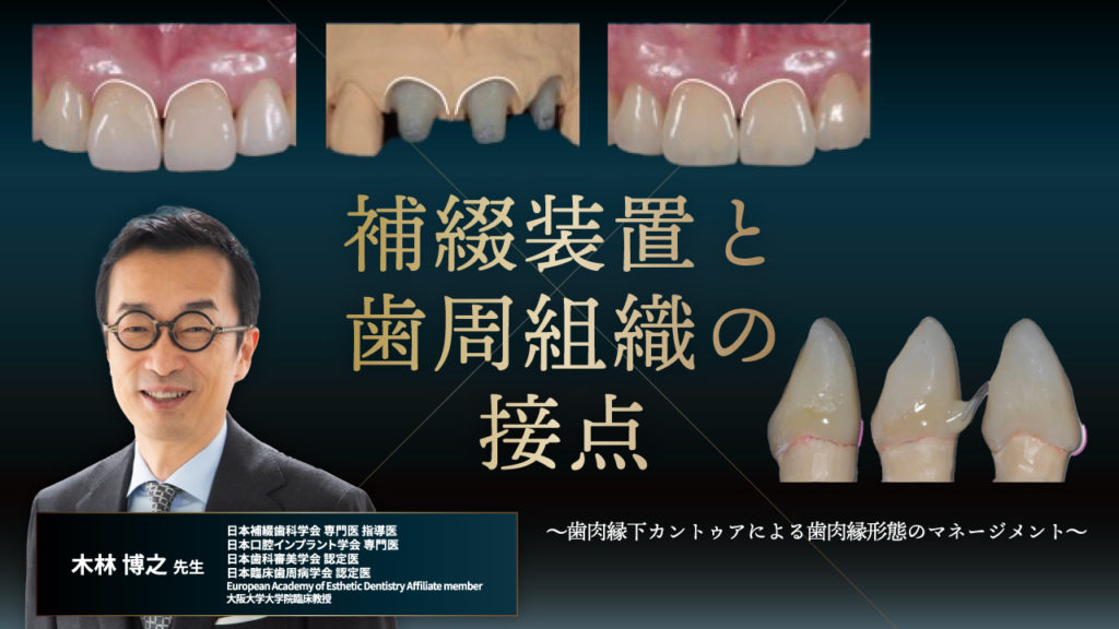 補綴装置と歯周組織の接点～歯肉縁下カントゥアによる歯肉縁形態のマネージメント～
