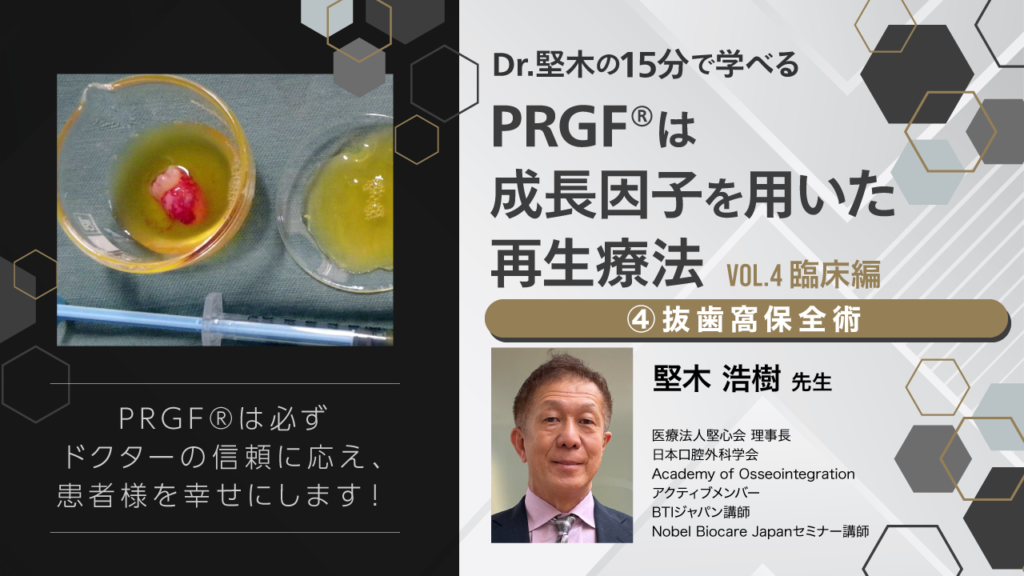 Dr.堅木の15分で学べる〜PRGF®は成長因子を用いた再生療法【Vol.4 ④抜歯窩保全術】〜