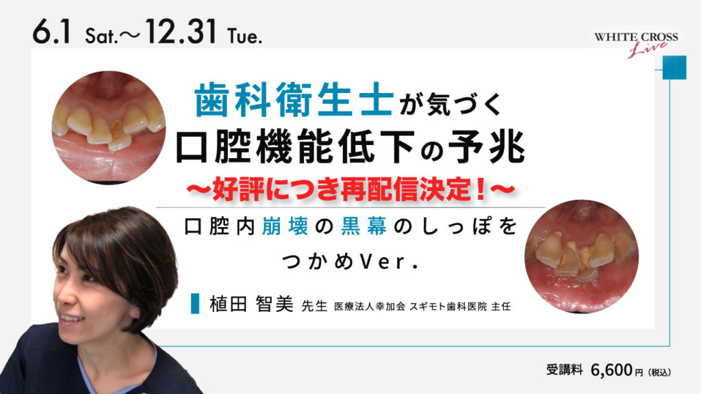 歯科衛生士が気づく口腔機能低下の予兆【再配信】
