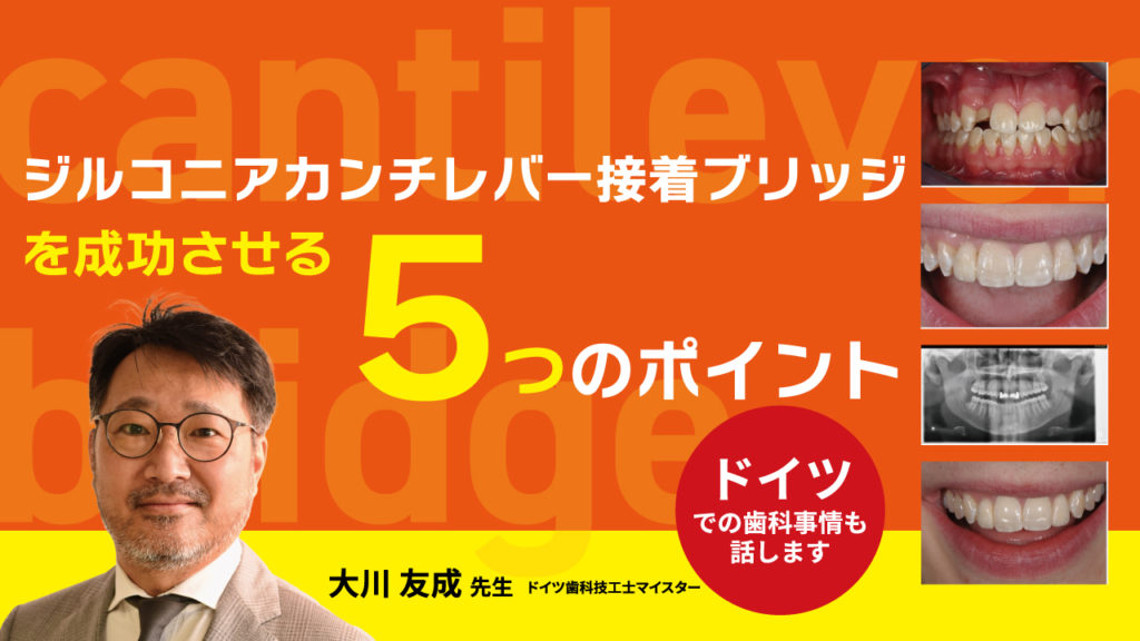 ジルコニアカンチレバー接着ブリッジを成功させる「5つ」のポイント