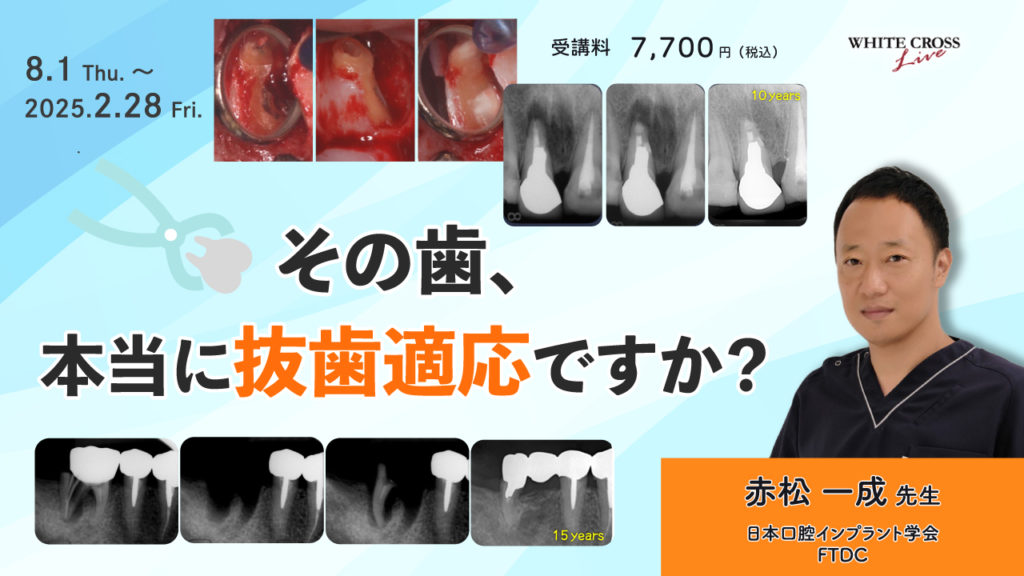 その歯、本当に抜歯適応ですか？